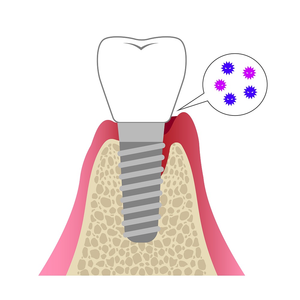 インプラント周囲炎とは？