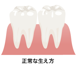 健康な親知らずの活用