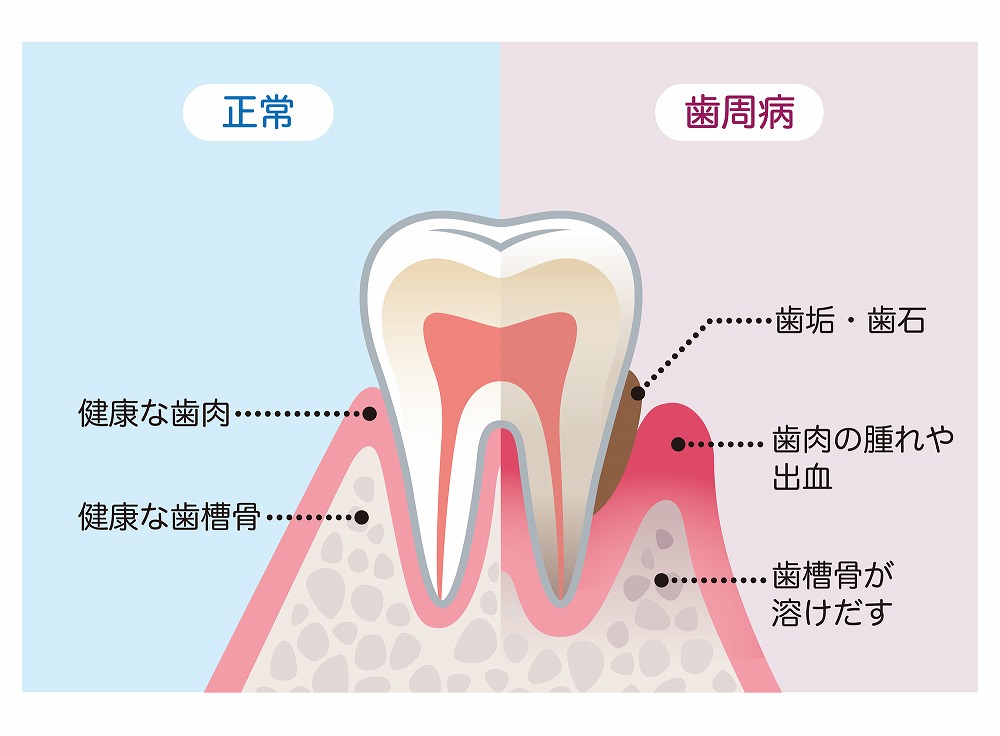 自覚症状の少ない歯周病