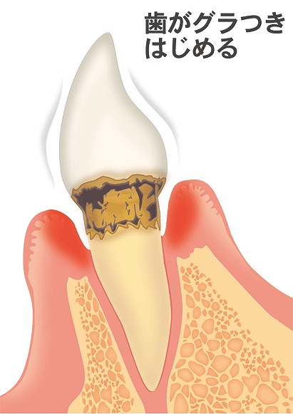 中度歯周炎