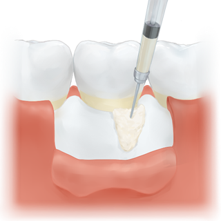 外科手術を伴わない歯周組織再生療法